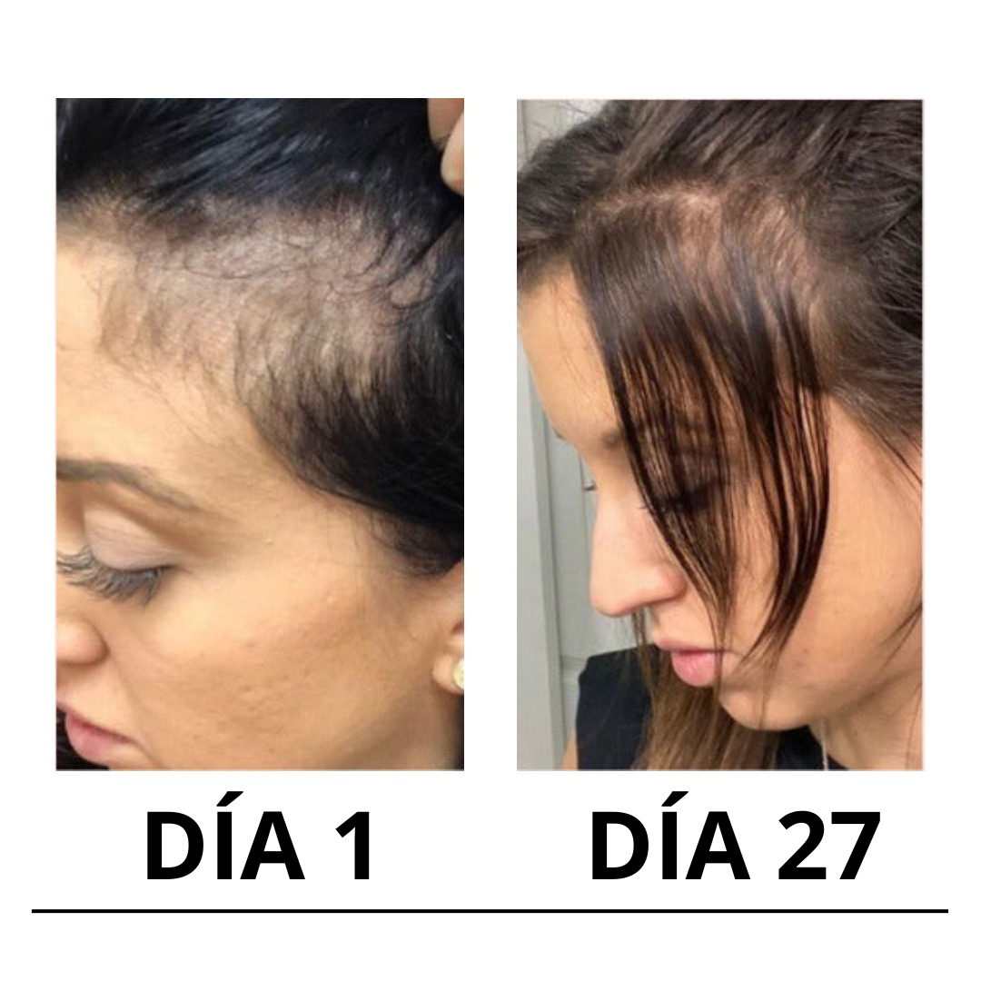 Cirvano™ | Serum de crecimiento de pelo y anticaída